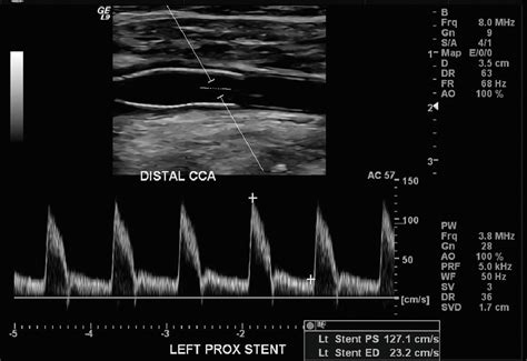 Carotid Endarterectomy Ultrasound