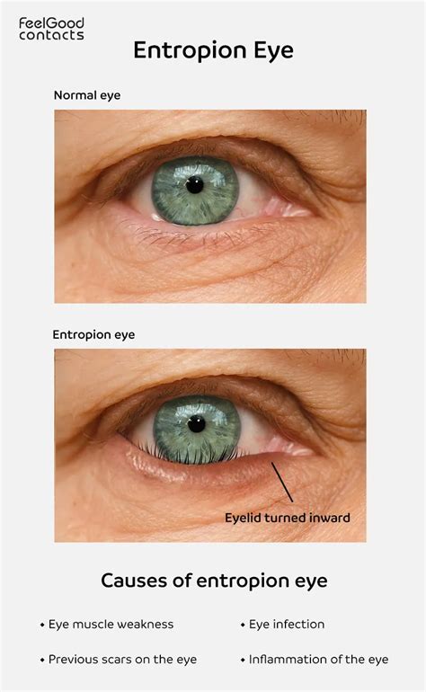 Entropion Eye Causes Symptoms Treatments Feel Good Contacts