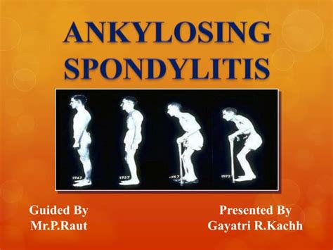 Ankylosing Spondylitis Ppt