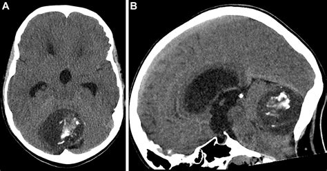 Intracranial Dermoid Cyst Radiology