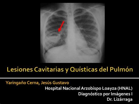 Lesiones Cavitarias Y Quísticas Del Pulmón