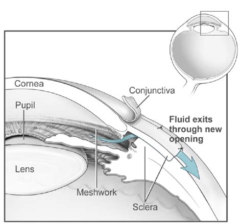 Glaucoma Plainfield Ophthalmology