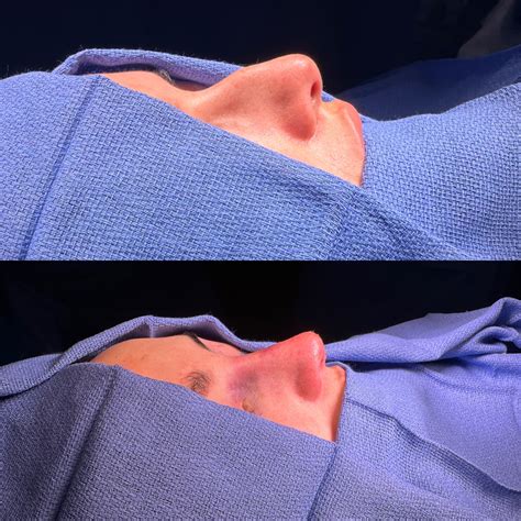 Before And After Female Primary Rhinoplasty Facial Plastic Surgeon