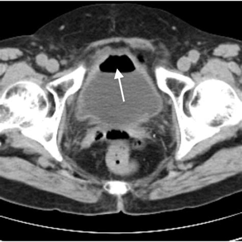 The Computed Tomography Scans Showing Gas Fluid Level Within The