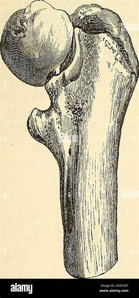 Fractura acetabular fotografías e imágenes de alta resolución Alamy