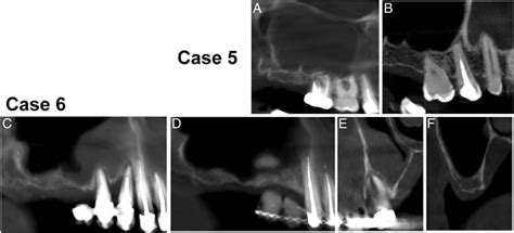 Mucositis In Maxillary Sinus