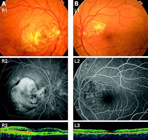 Choroidal Neovascular Membrane