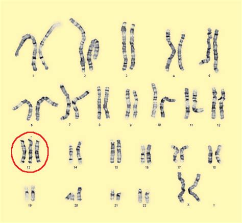 What Is Trisomy 13? - StoryMD