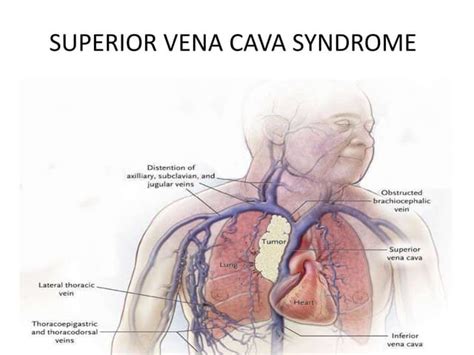 Superior Vena Cava Syndrome Ppt