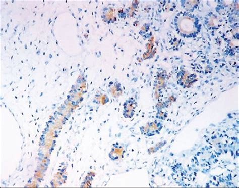 Sertoliform Endometrioid Tumor Of Ovary Presenting As Torsion Journal