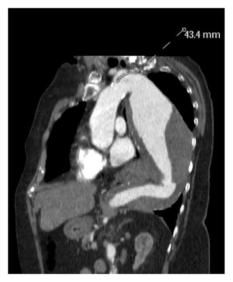 Descending Thoracic Aortic Aneurysm—a Axial Ct Scan Image Shows A Download Scientific Diagram