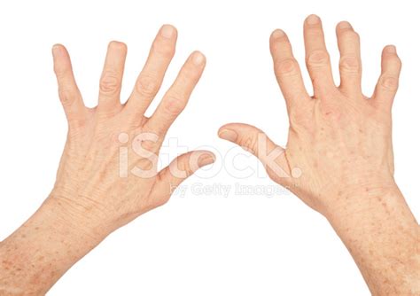 Amputated Finger And Arthritis Stock Photo | Royalty-Free | FreeImages