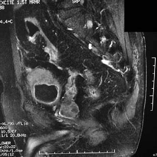 Pelvic Sagittal Magnetic Resonance Imaging Section Spin Echo T