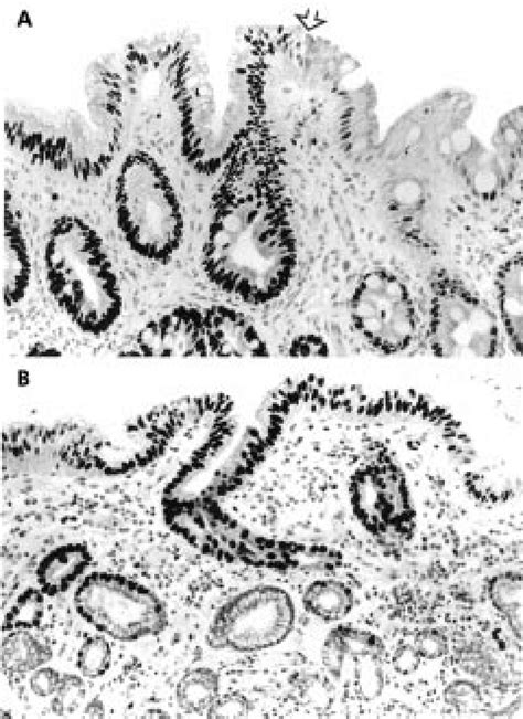 Minichromosome Maintenance Protein Mcm Expression In Barretts