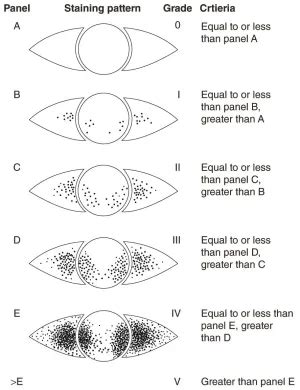 Oxford Grading System - American Academy of Ophthalmology