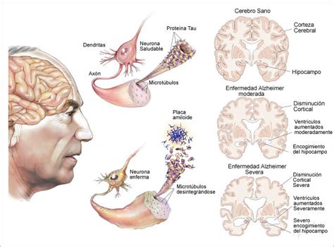 Enfermedad De Alzheimer ¿cuáles Son Las Teorías Más Aceptadas Que Explican Por Qué Se Produce