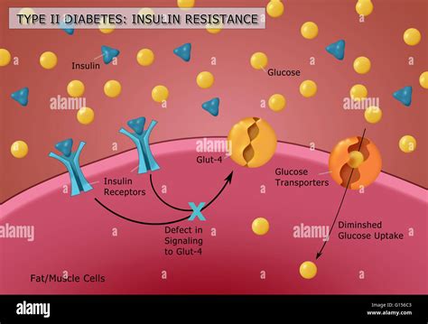 Ilustración de la producción de insulina y glucosa en la diabetes tipo