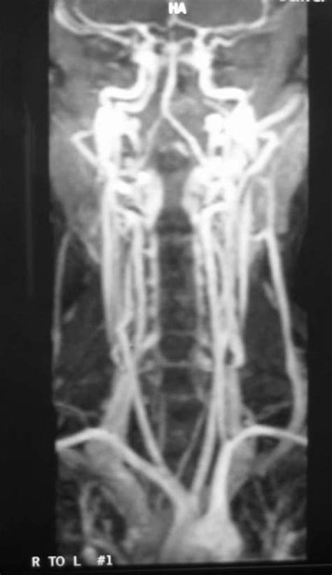 Contrast Enhanced Magnetic Resonance Angiogram Demonstrating The