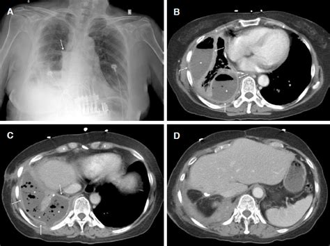 Chest Radiograph And Computed Tomography Ct Showing Empyema The