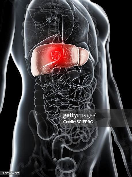 Liver Tumor Photos And Premium High Res Pictures Getty Images