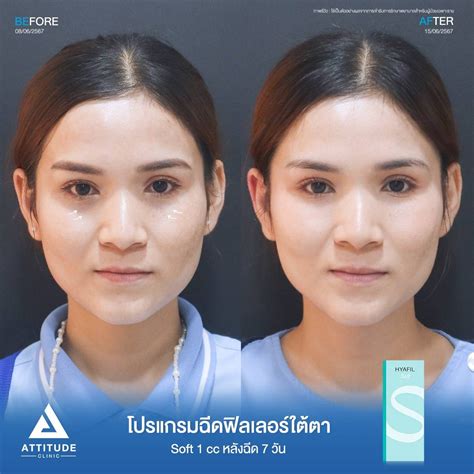 รีวิว Attitude Clinic ห้วยขวาง รีวิวโปรแกรมฉีดฟิลเลอร์ใต้ตารุ่น S