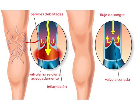 Qué son las varices Clínica Salus Medical Clinic