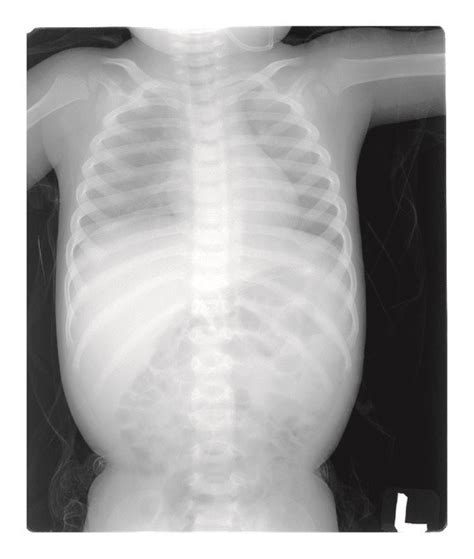 X-ray: the previous multiple bony fractures with callus formation are ...