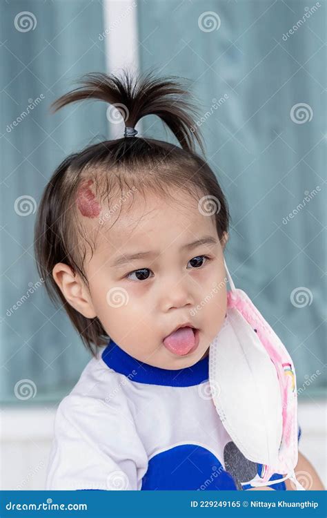 Adorable Little Child Girl With Big Capillary Strawberry Hemangiomas