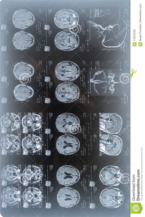 MRI Scan of the Human Brain Stock Photo - Image of radiology, head ...