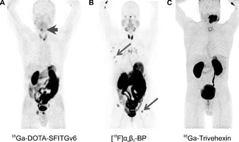 V Integrin Pet Imaging In Cancer Patients Maximum Intensity