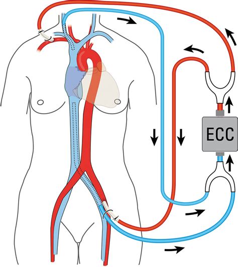 Schematic Drawing Of Cardiopulmonary Bypass Connection ECC