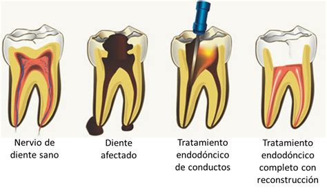 Por qué se pone negra una muela Urgencias dentales