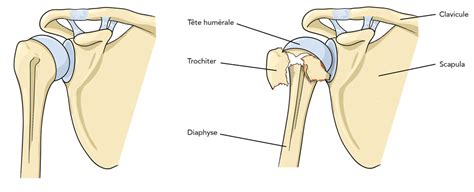 Les fractures de l épaule humérus proximal