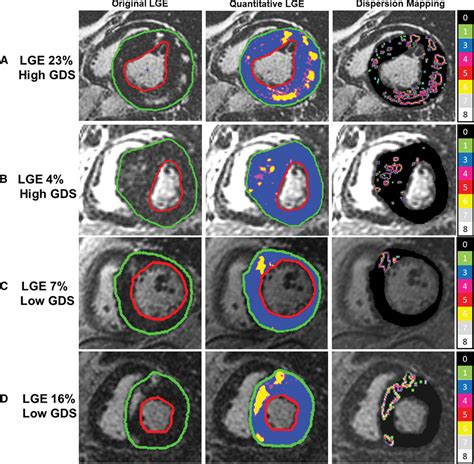 Late Gadolinium EnhancementDispersion Mapping Circulation