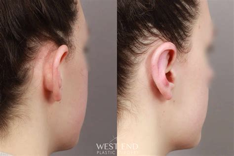 Otoplasty Before After