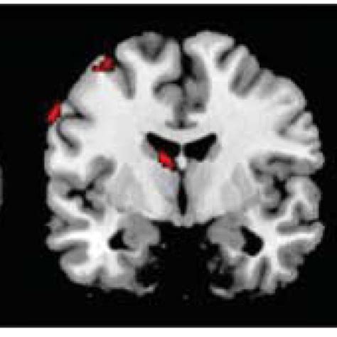 Areas Of Reduced Gray Matter Volume Associated With Reduced Score On