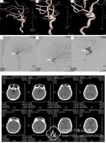 神经外三科成功开展颅内动脉瘤覆膜支架新技术治疗 特色技术 特色诊疗 就医版 山东第一医科大学第一附属医院（山东省千佛山医院）【官方网站】