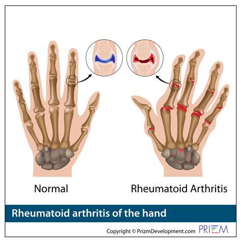 Arthritis of the Hand and Wrist | Lakelands Orthopedics