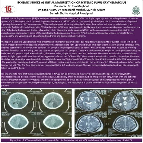 Pdf Ischemic Stroke As Initial Manifestaion Of Systemic Lupus