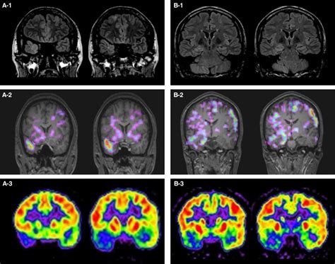 Brain Magnetic Resonance Imaging MRI Subtracted Ictal Interictal