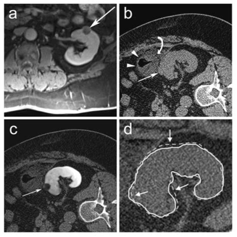 Image Registration Of Pre Procedural Mri And Intra Procedural Ct Images To Aid Ct Guided