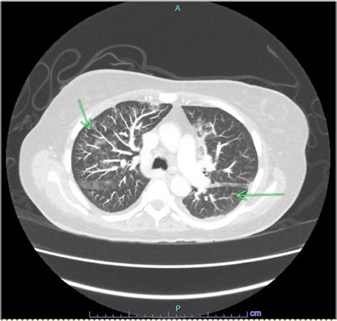 Patient's axial chest CT scan with contrast, where two green arrows ...