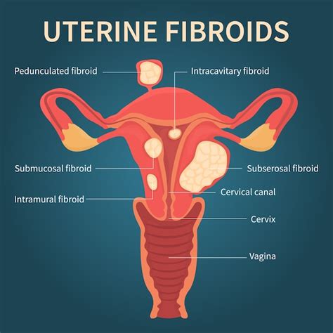 Premium Vector Uterine Fibroids In The Female Reproductive System