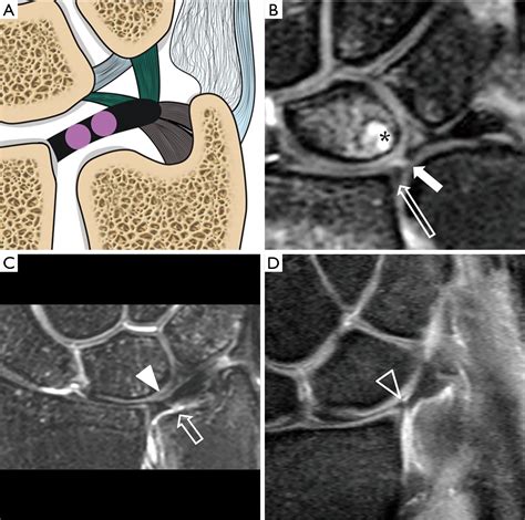 Triangular Fibrocartilage Complex Tfcc Tear Mri