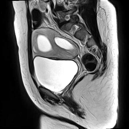 Ovarian Torsion Radiology Case Radiopaedia Org