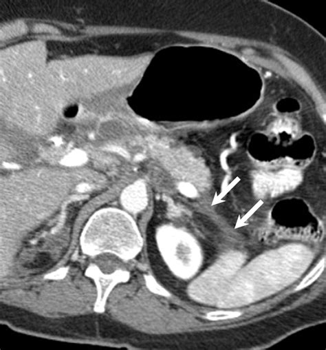 Pancreas Peritoneal Reflections Ligamentous Connections And Pathways