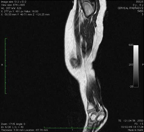 Figure 4 From Popliteal Pterygium Syndrome Semantic Scholar