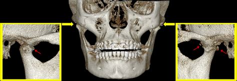 Osteoartrosis de ATM Dento Metric Radiología Dental Oral y