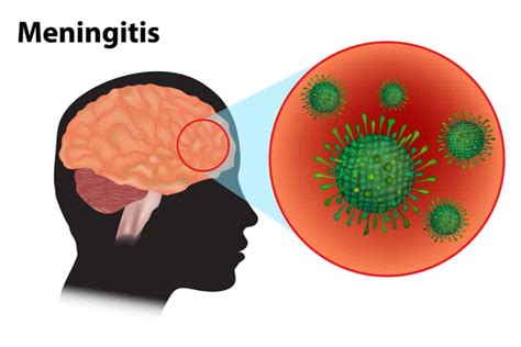 TB Meningitis Stages: The Importance of Early Detection