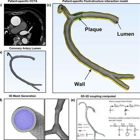 Step By Step Method For The 3D FSI Patient Specific Model Generation A